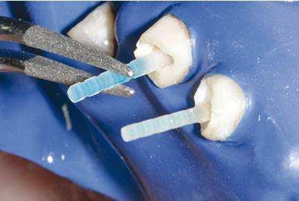 纤维桩——牙科修复的好材料